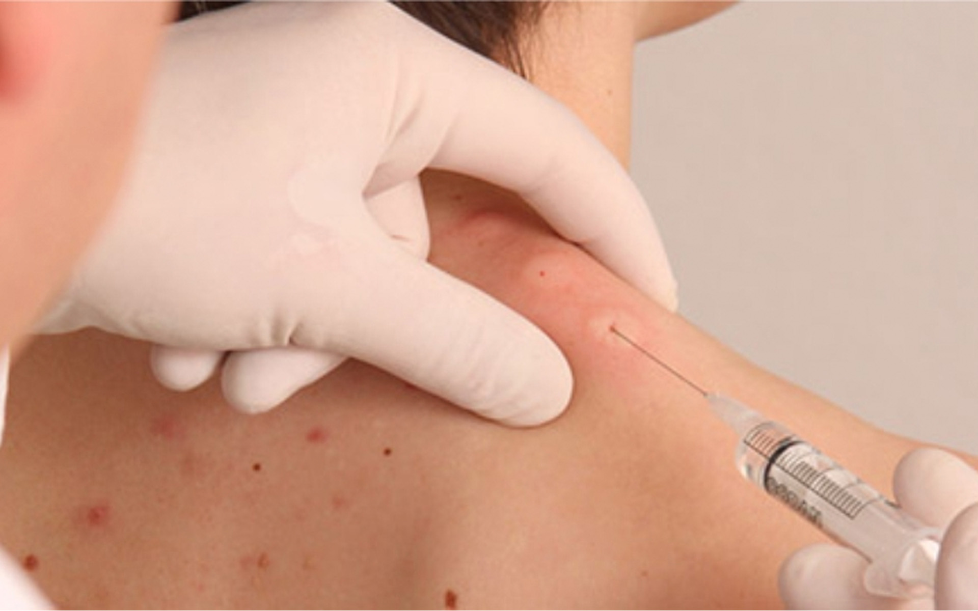 Terapia Neural Huneke